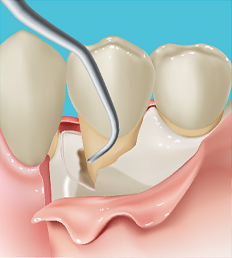 歯周組織再生剤投与