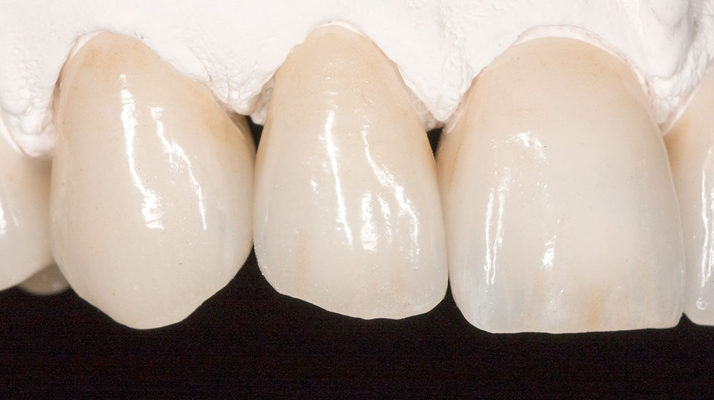 e.max（イーマックス）クラウン