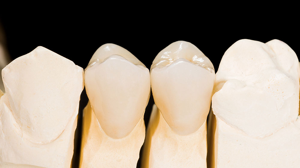 ジルコニアクラウン