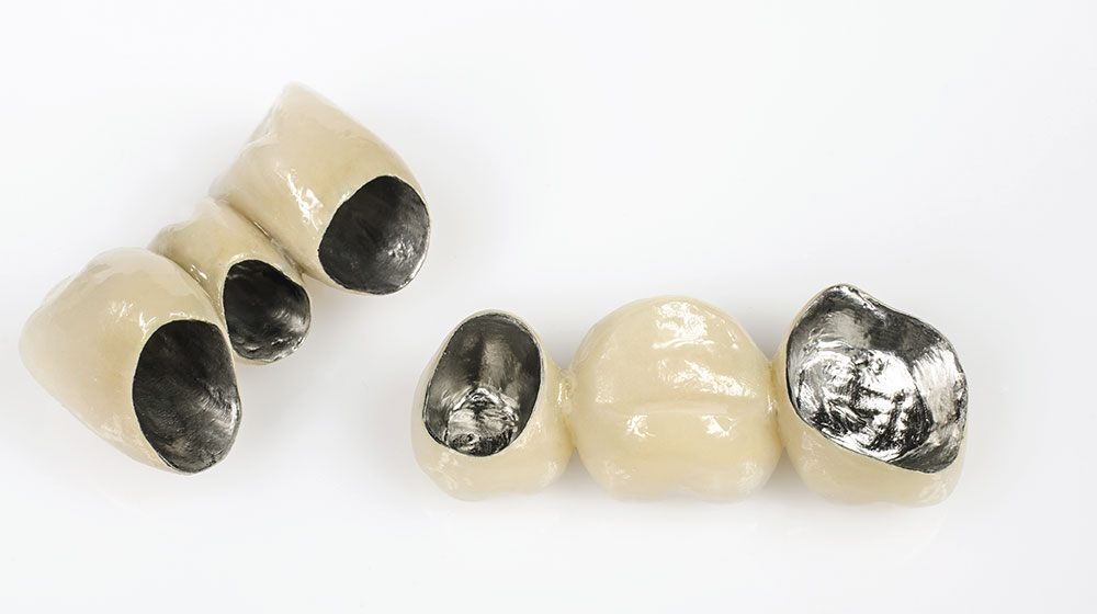 メタルボンドクラウン