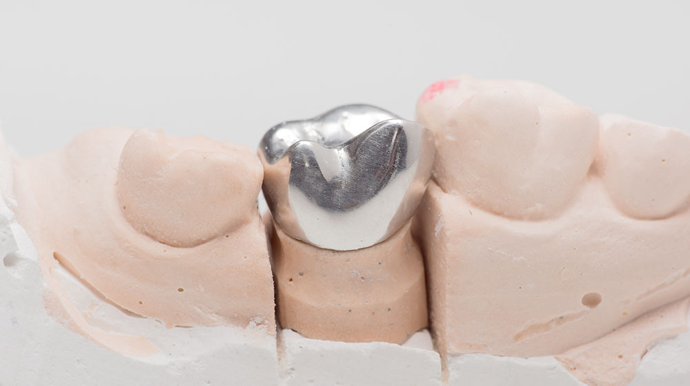 銀歯クラウン（保険適応）