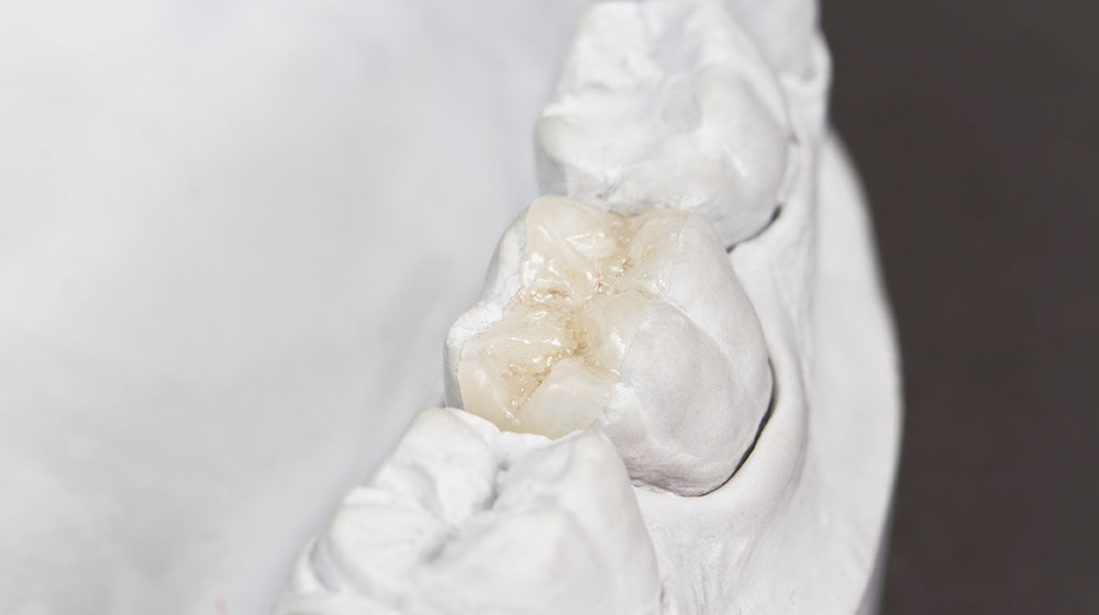 e.max（イーマックス）インレー