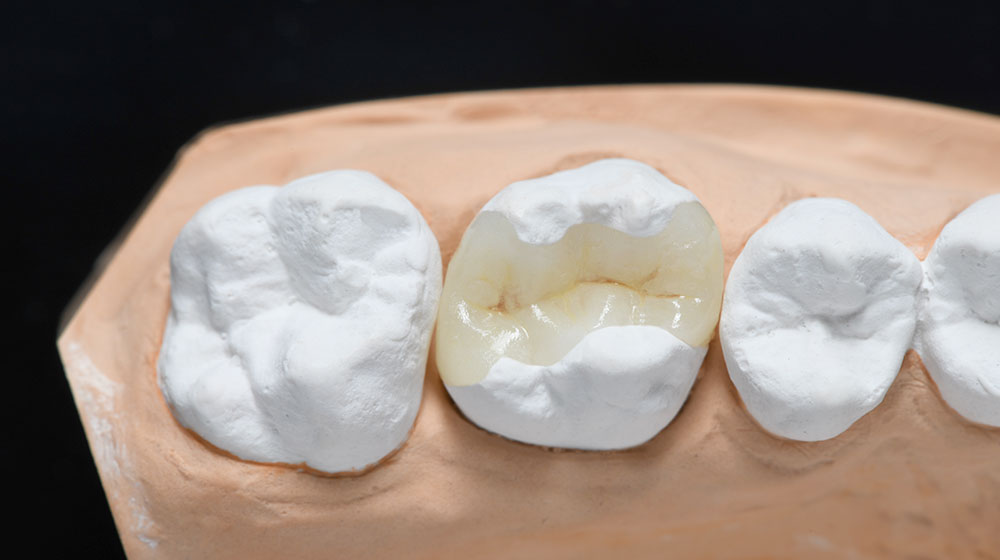 ジルコニアインレー