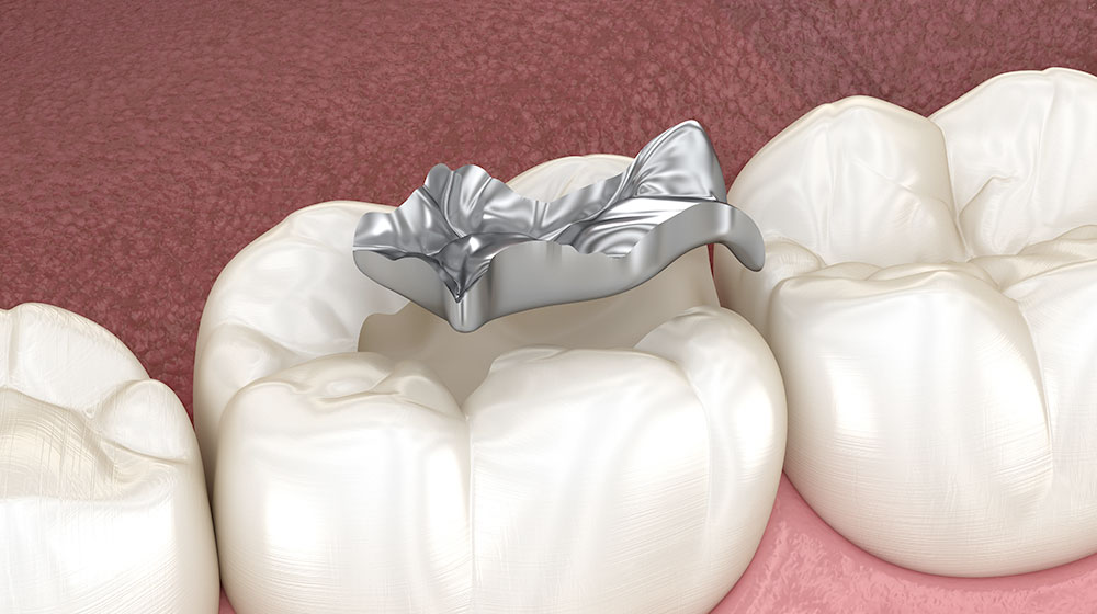 銀歯インレー（保険適応）