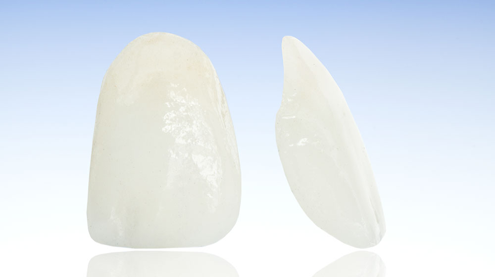 ラミネートベニア