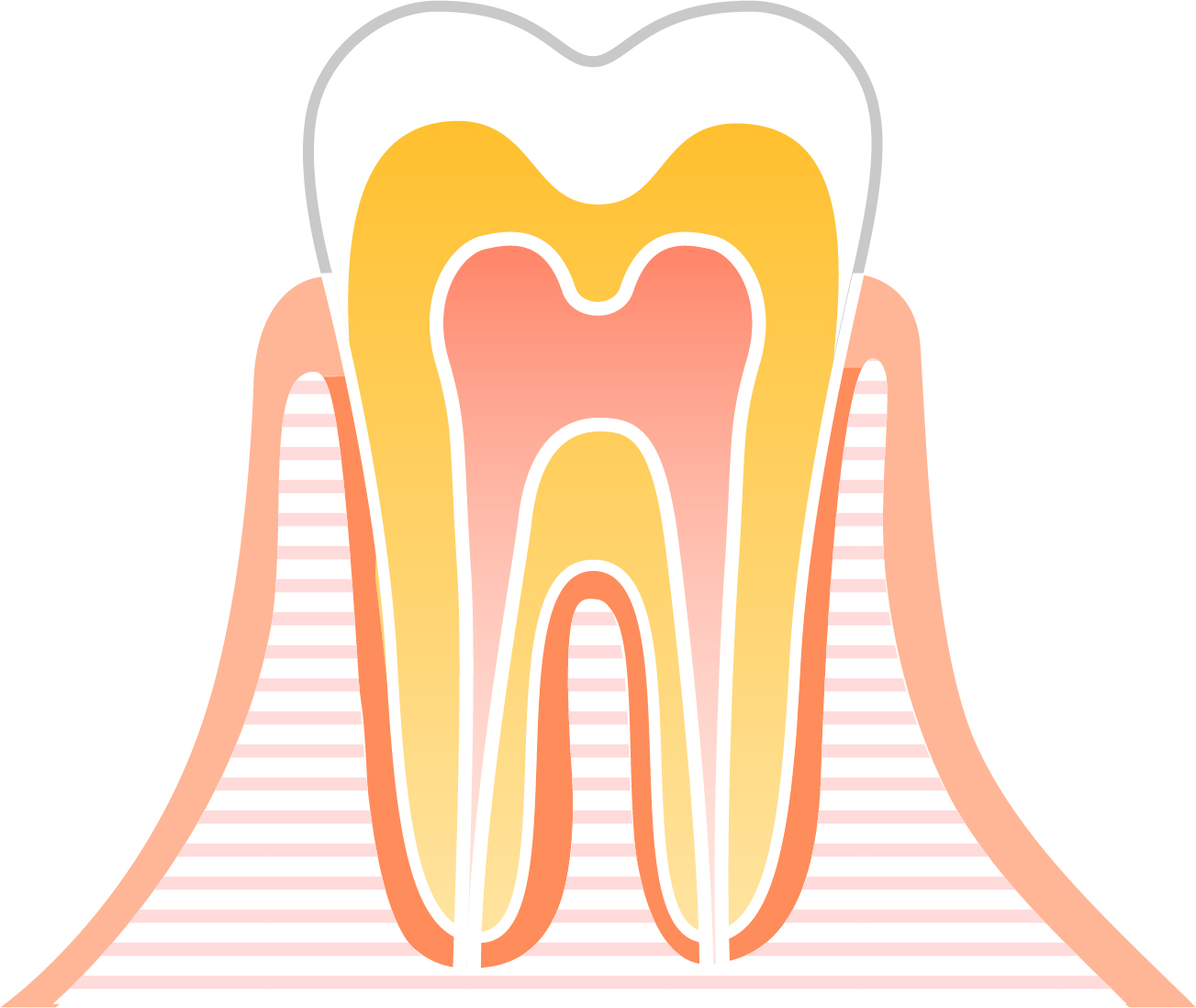 CO（シーオー）:経過観察の虫歯
