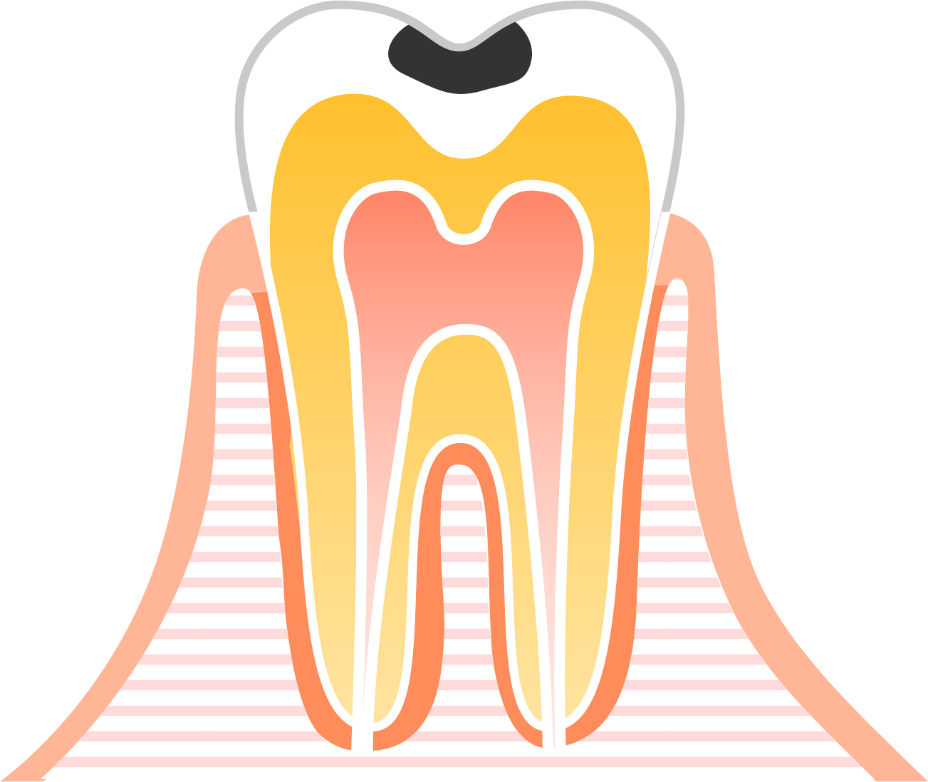 C1（シーワン）:エナメル質の虫歯