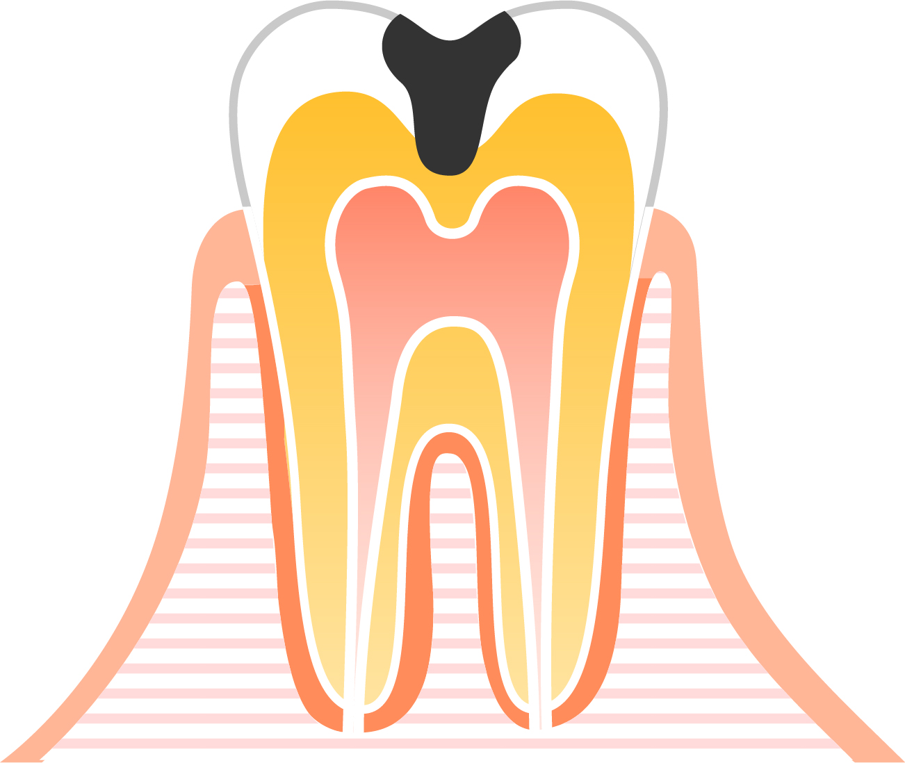 C2（シーツー）:象牙質の虫歯