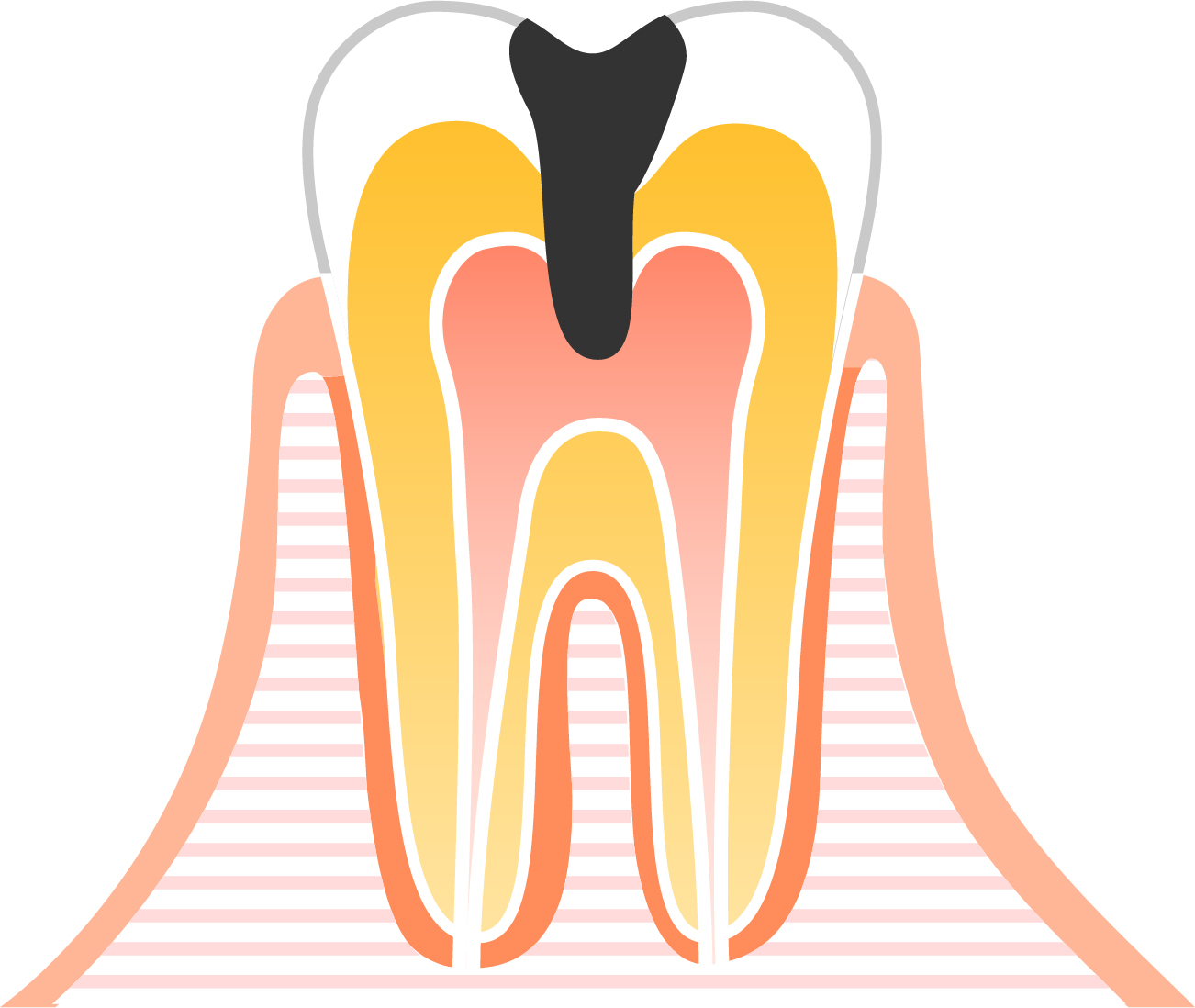 C3（シースリー）:歯髄の虫歯