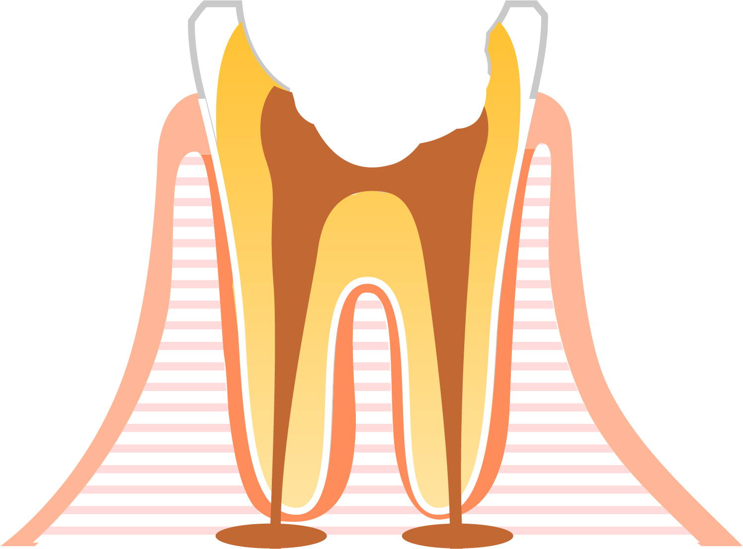 C4（シーフォー）:歯髄が壊死した虫歯