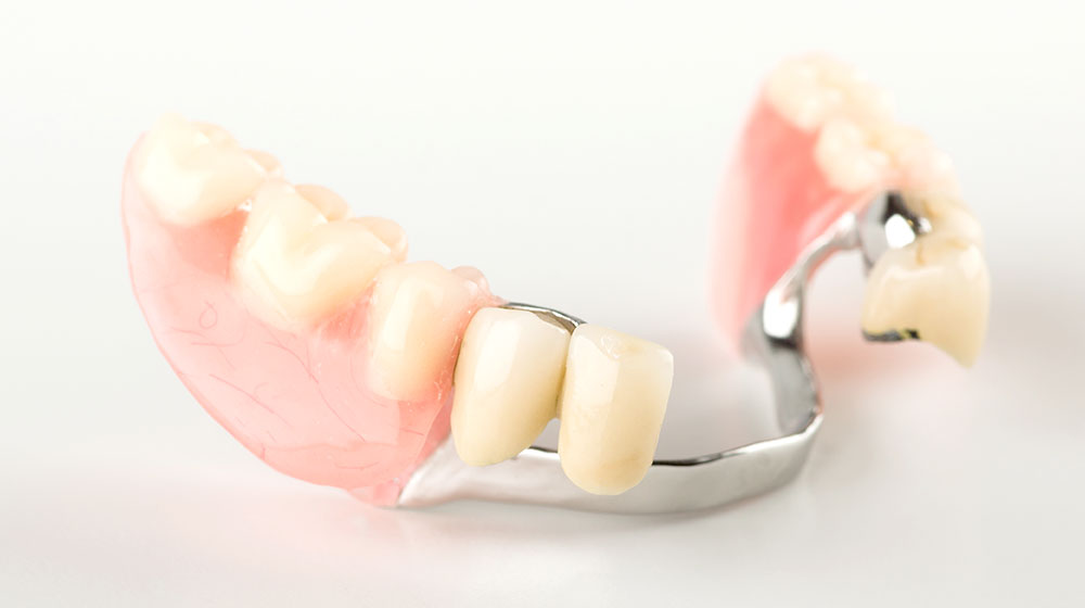 コーヌスクローネ義歯