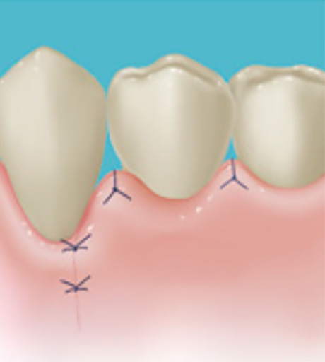 歯周組織の再生