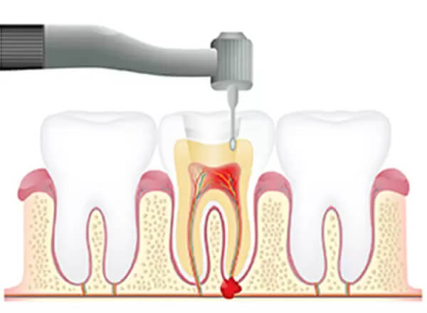 感染した歯髄の除去