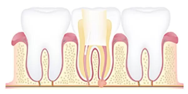 土台と被せ物の接着