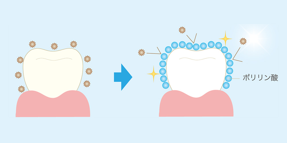 分割ポリリン酸で歯を予防コーティング